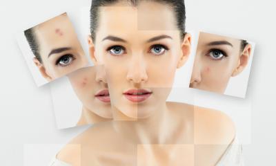 Combattere l'acne Combattere l'acne
