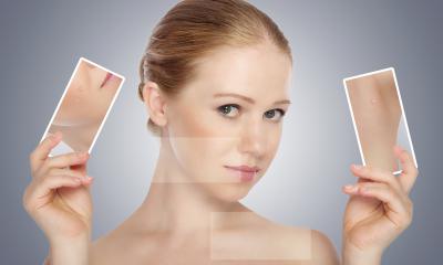 Peeling chimico Peeling chimico