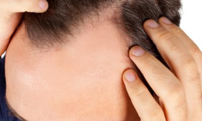 Come prevenire la calvizie con successo