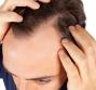 Come prevenire la calvizie con successo