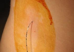 Anestesia epidurale