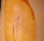 Anestesia epidurale