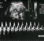 Cardiotocografia