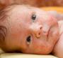 Acne neonatale: cosa è e cosa fare