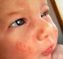 Dermatiti del neonato