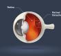 Retina