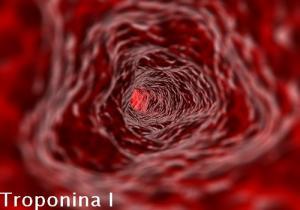 Troponina I