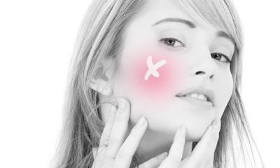 Acne rosacea 