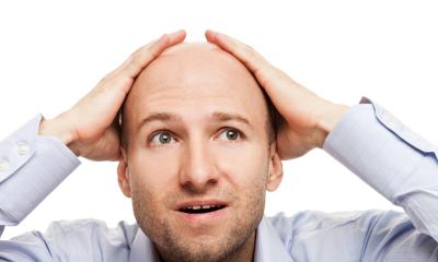 Alopecia androgenetica 