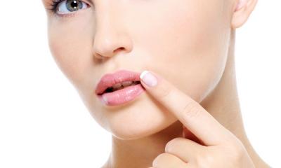 Herpes labiale