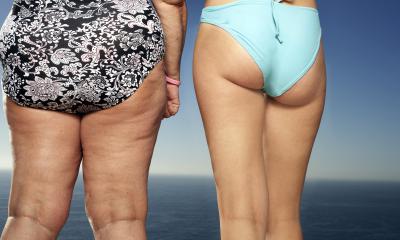 Lipedema