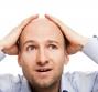 Alopecia androgenetica 