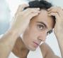 Alopecia areata 