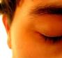 Ectropion