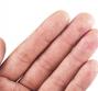 Eczema alle mani