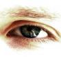 Glaucoma
