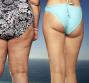 Lipedema